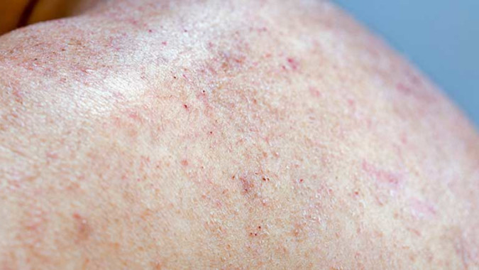 Dermatitis case study image