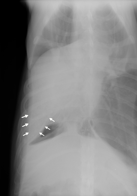 Read About Respiratory Medicine In This Article By John C Gicking And Marcel Aumann Read About Respiratory Medicine In This Article By John C Gicking And Marcel Aumann