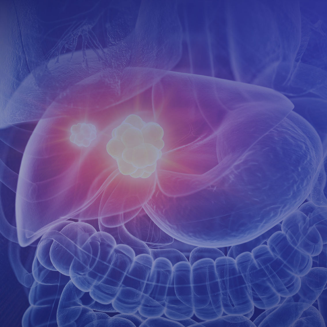 Medical Crossfire®: Individualizing Treatment Plans in Advanced Hepatocellular Carcinoma Based on Biology and Other Patient Characteristics