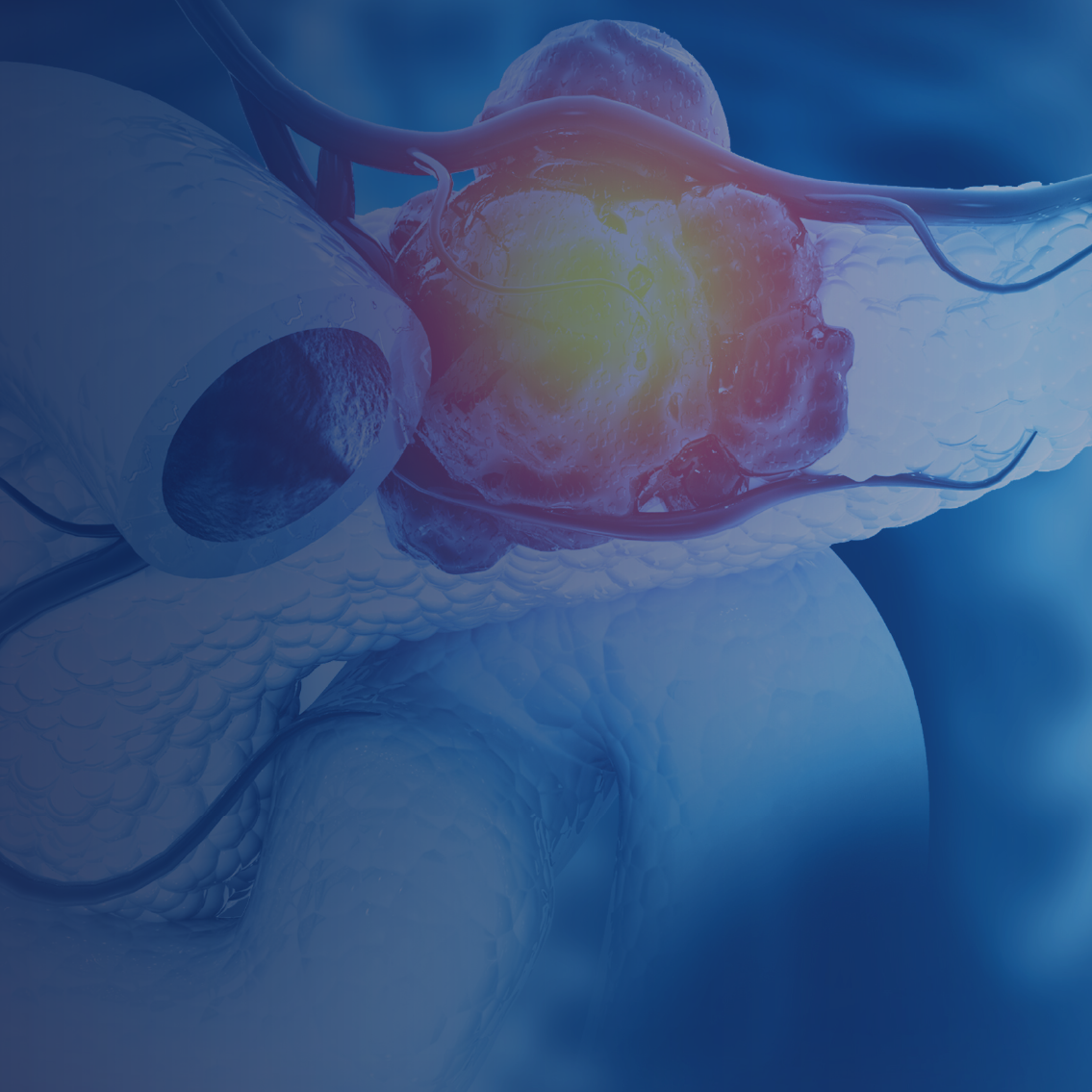 Tumor Board: Molecular Testing and Personalized Strategies in Pancreatic Cancer: Targeting NRG1 and Rare Drivers with an Optimized Approach