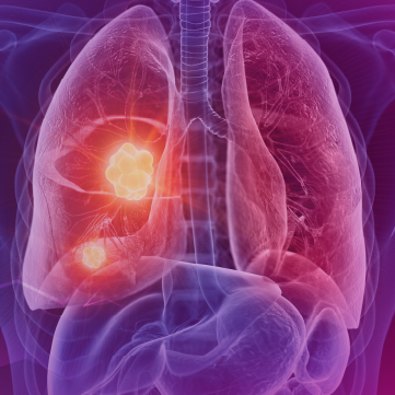 Lung Cancer Tumor Board®: The Pivotal Role of Multimodal Therapy in Leveraging Immunotherapy for Stage I-III NSCLC When the Goal is Cure