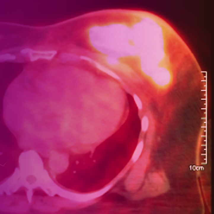 Cases and Conversations™: The Experts Explain How They Integrate PET Imaging Into Metastatic HR+ Breast Cancer Care Settings