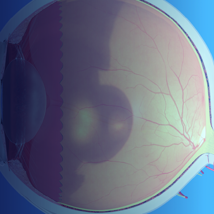 Novel Therapies for Neovascular Retinal Disease – Expert Analysis of New Key Data