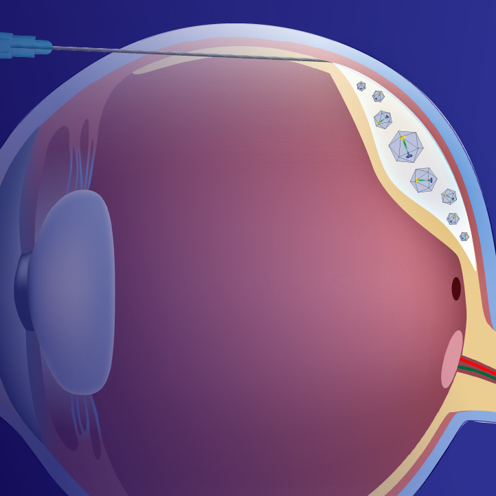 Latest Advances in X-Linked Retinitis Pigmentosa: Optimizing Diagnosis and Developments in Gene Therapy