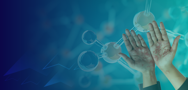 Where Do Biologics Fit Into the Management of Moderate-to-Severe Atopic Dermatitis?