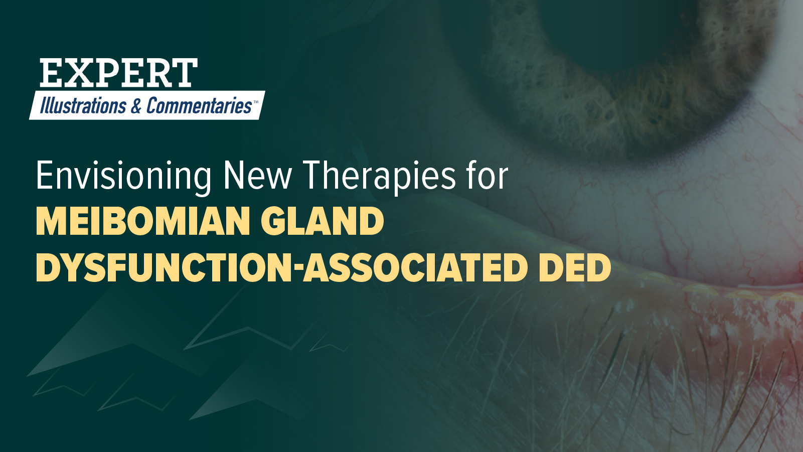Expert Illustrations & Commentaries™: Envisioning New Therapies for Meibomian Gland Dysfunction-Associated DED