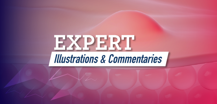Expert Illustrations & Commentaries™: Exploring Novel Therapeutic Targets in Acne Management