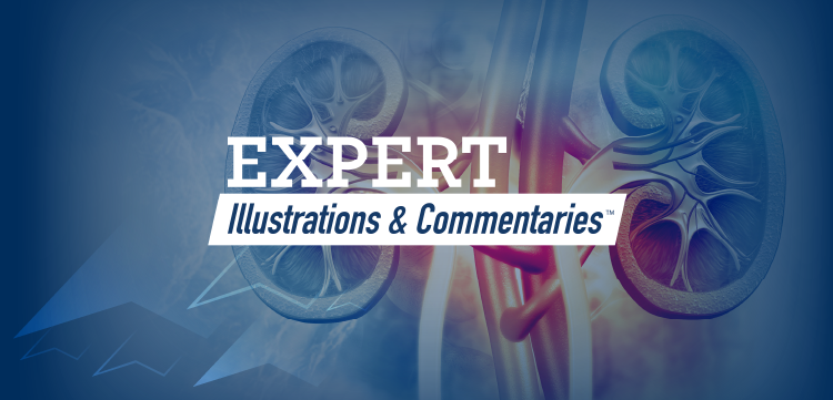 Expert Illustrations and Commentaries™: The Role of the Paracellular Pathway in the Management of Hyperphosphatemia in CKD