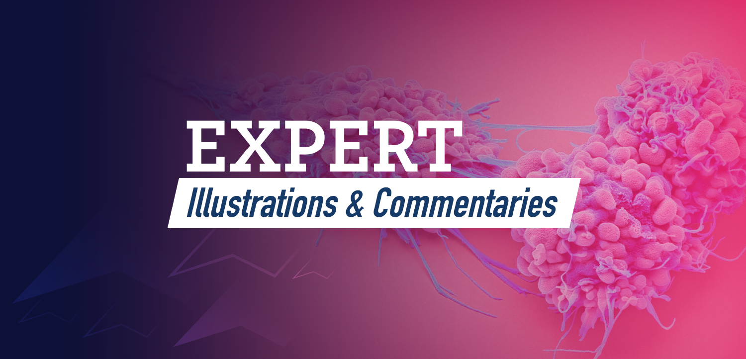 Expert Illustrations and Commentaries™: Visualizing Glucocorticoid Receptor Modulation in Platinum-Resistant Ovarian Cancer—Looking at Novel Pathways With an Eye Toward the Future of Treatment