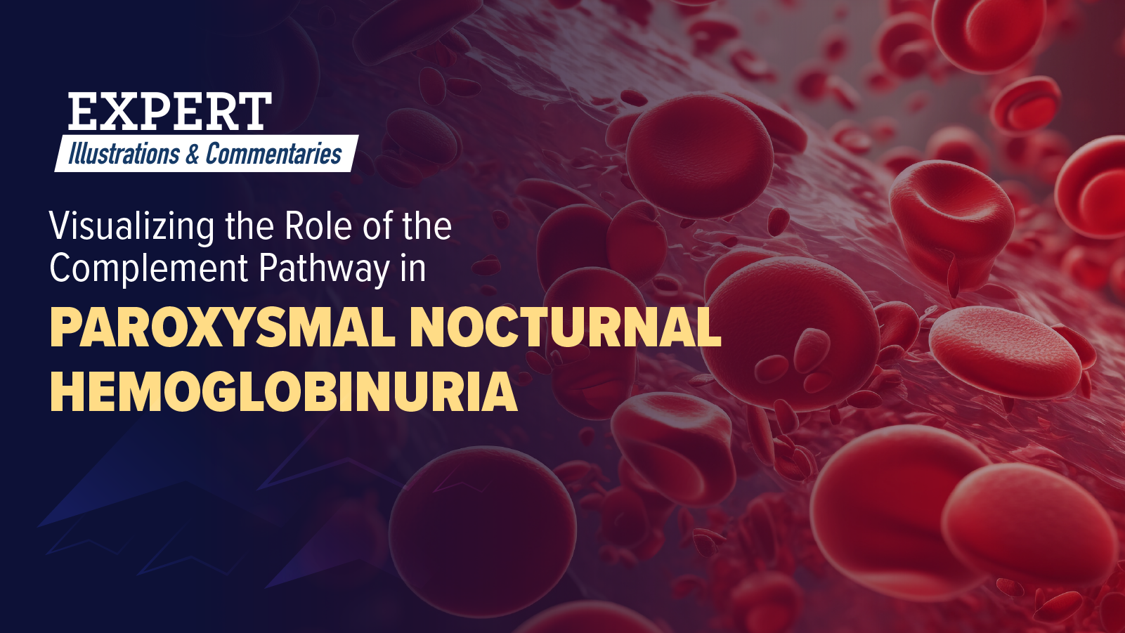 Expert Illustrations & Commentaries™: Visualizing the Role of the Complement Pathway in Paroxysmal Nocturnal Hemoglobinuria