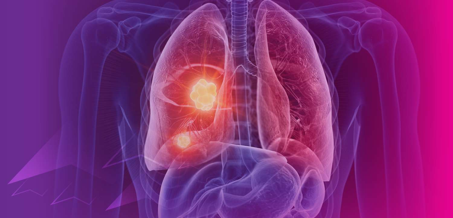 (MOC and CME Credit) Lung Cancer Tumor Board®: The Pivotal Role of Multimodal Therapy in Leveraging Immunotherapy for Stage I-III NSCLC When the Goal Is Cure