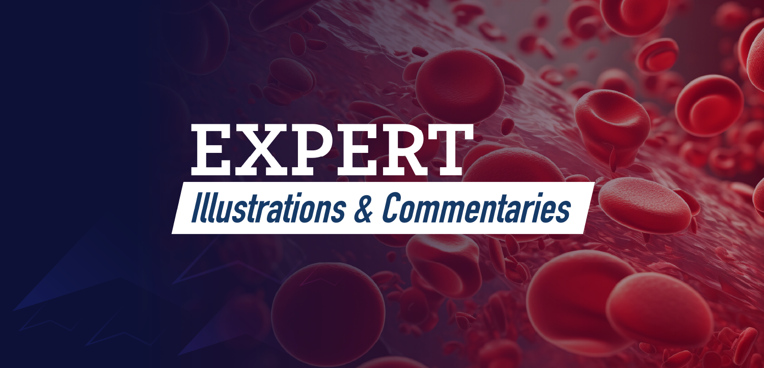 Expert Illustrations & Commentaries™: Visualizing the Role of the Complement Pathway in Paroxysmal Nocturnal Hemoglobinuria