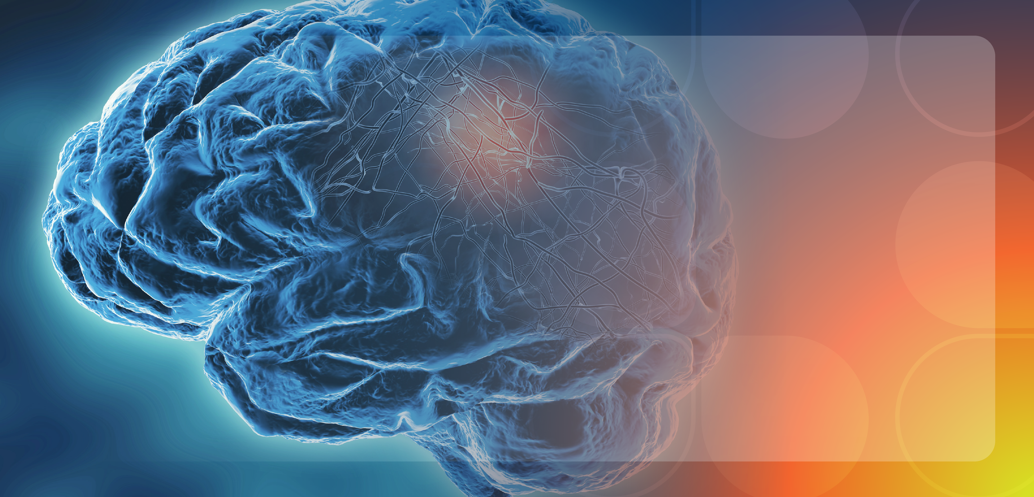 Advancing Targeted Therapies Aimed at Smoldering Disease in Multiple Sclerosis