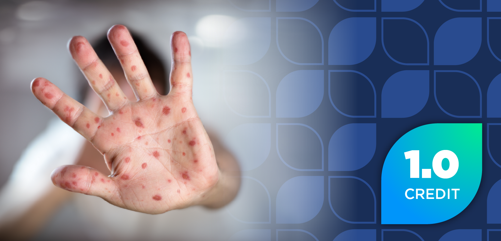 Beyond the Spots: Management of Measles