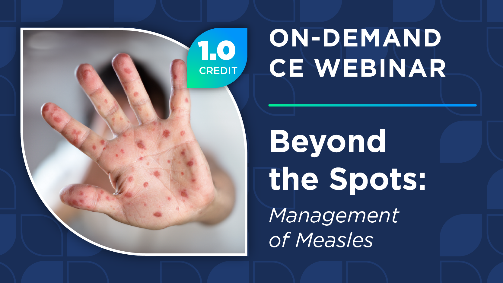 Beyond the Spots: Management of Measles