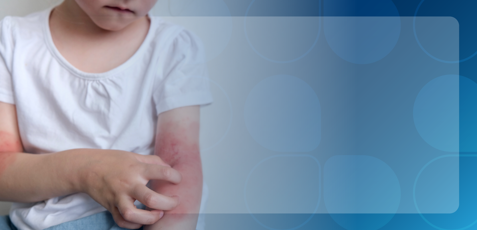 Navigating the Complexities of Biologic Therapy for Moderate to Severe Atopic Dermatitis in Children: The Impact of Pharmacists on Patient Care
