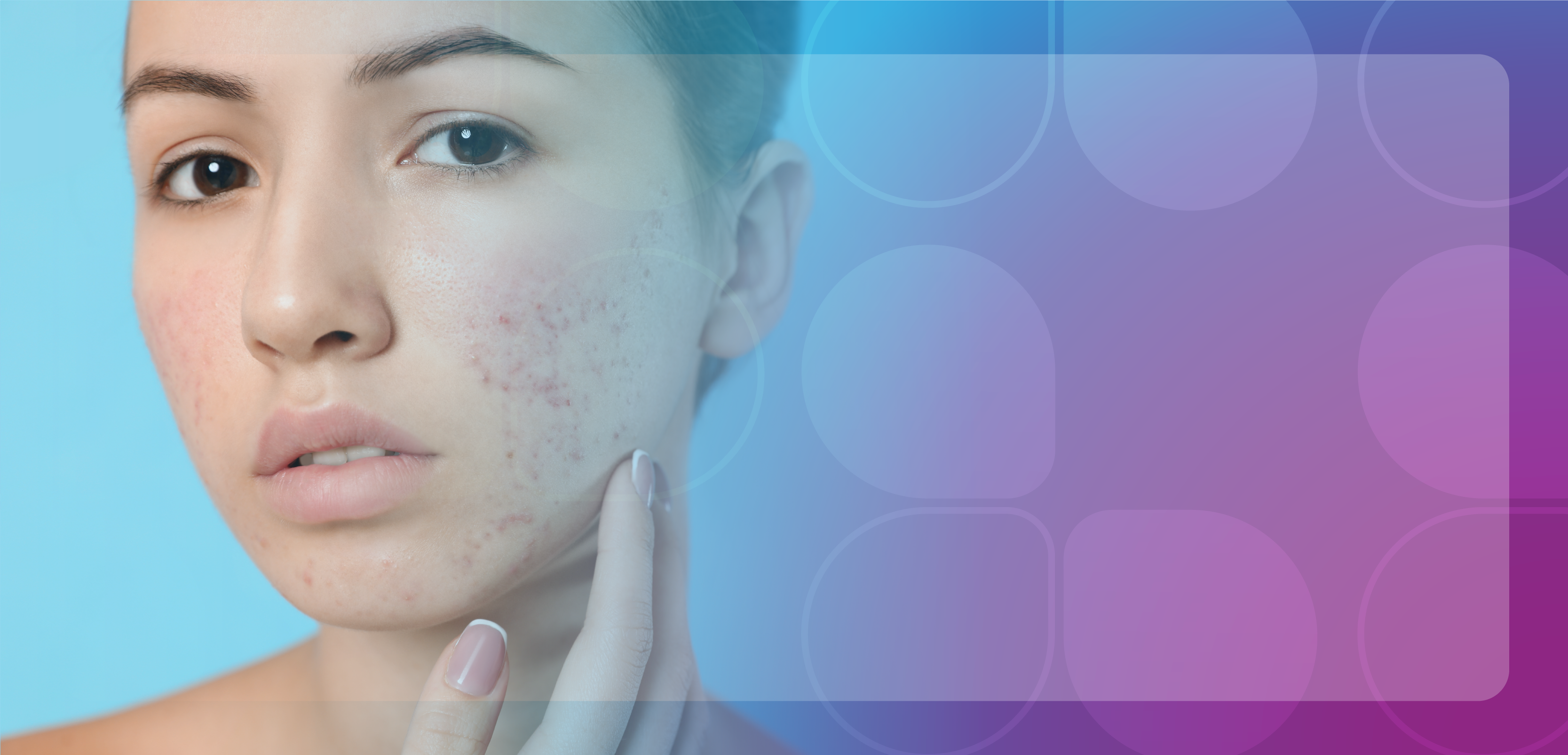 Alleviating Patient Burden in Acne: Utilizing Ceramides to Address Skin Barrier Dysfunction (Pharmacy Technician Credit)