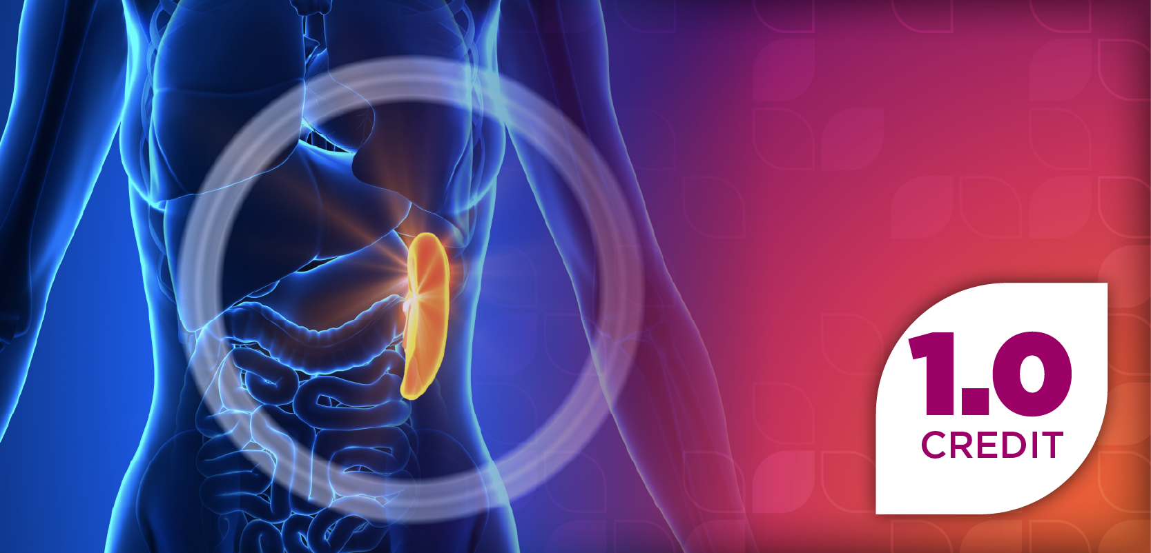 Exploring Therapeutic Advances in Myelofibrosis and Key Considerations for Effective Management