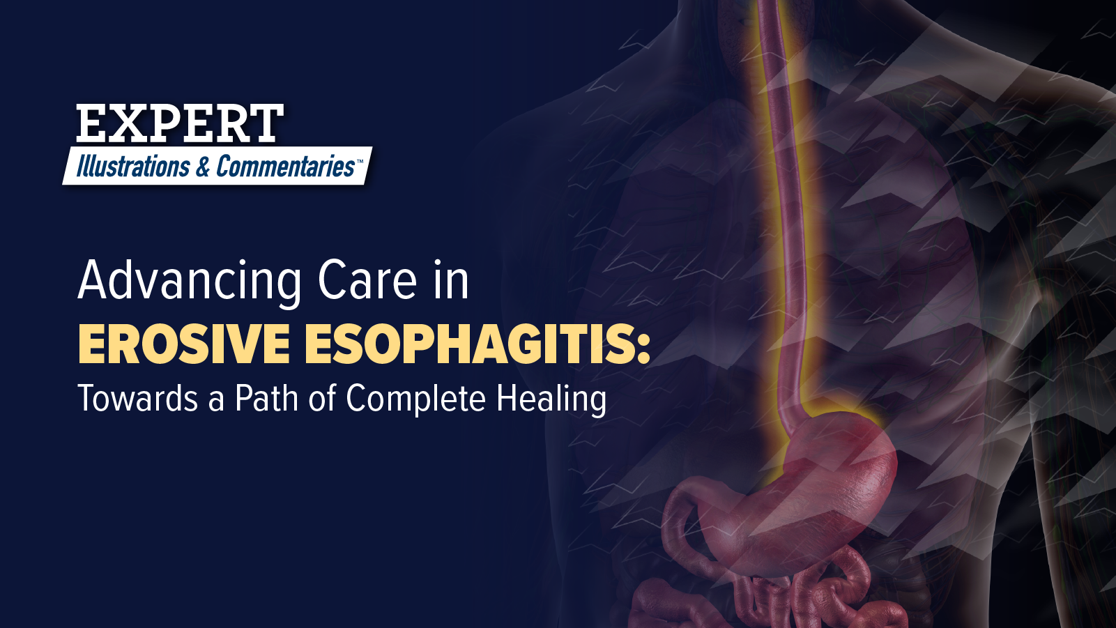 Expert Illustrations and Commentaries™: Advancing Care in Erosive Esophagitis: Towards a Path of Complete Healing